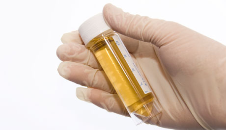 Bacterial Cystitis Bacterial Cystitis