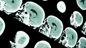 Central Nervous System Embryonal Tumors Central Nervous System Embryonal Tumors