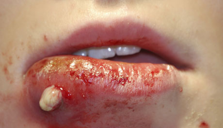 MRSA Infection Pictures, Treatment, and Symptoms